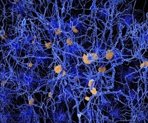 Study reveals potential to monitor progression of Alzheimer’s disease by measuring brain antioxidant levels