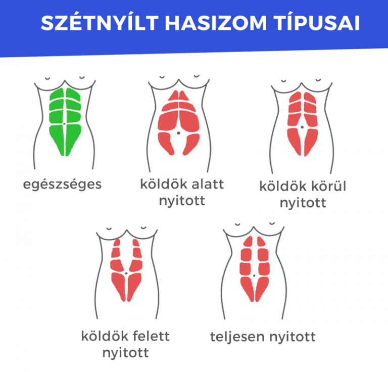 szétnyílt hasizom