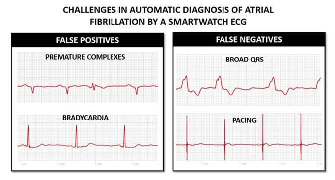 Are smartwatch health apps to detect atrial fibrillation smart enough?