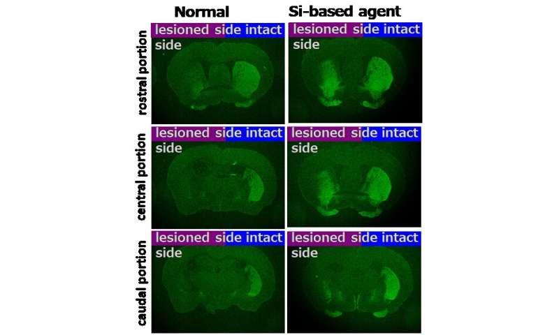 Antioxidant agent may prevent chronic kidney disease and Parkinson's disease