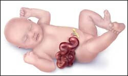The figure above is an illustration of a baby born with gastroschisis.