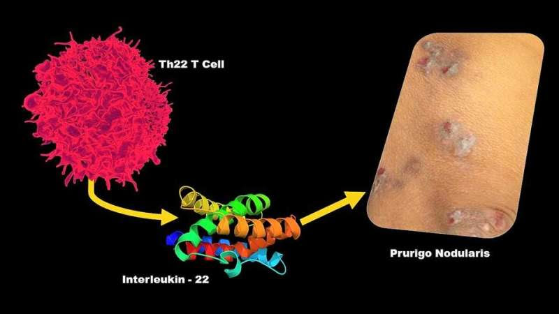 Researchers discover novel mediator of once-mysterious chronic itch