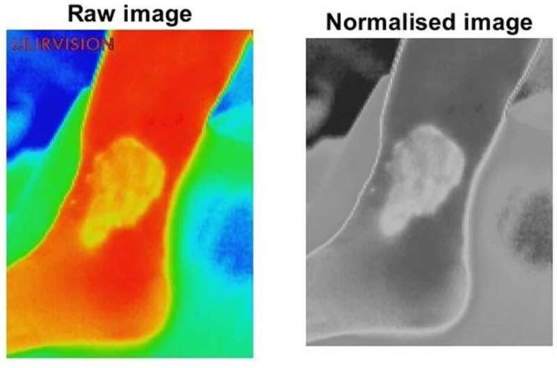 Contactless screening tool could revolutionise chronic wound treatment