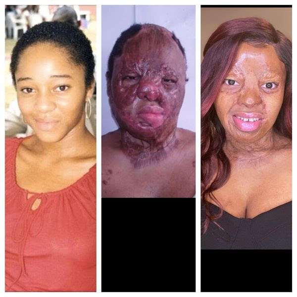  I?m grateful I lived long enough to see it - Plane crash survivor, Kechi Okwuchi bares her facial scars as she shares recovery journey 