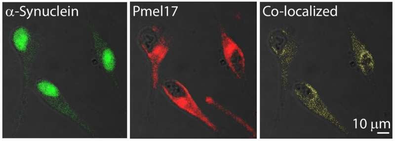 An amyloid link between Parkinson's disease and melanoma