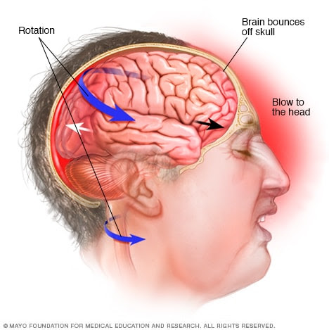 A sudden jolt moves the brain inside the head.