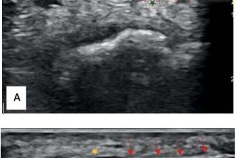 Non-surgical treatment relieves carpal tunnel syndrome