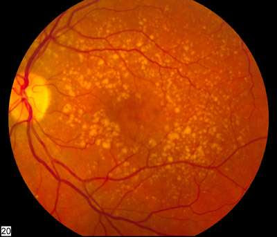 age-related macular degeneration (AMD)