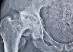 Osteonecrosis, opciones para tratar un infarto óseo
