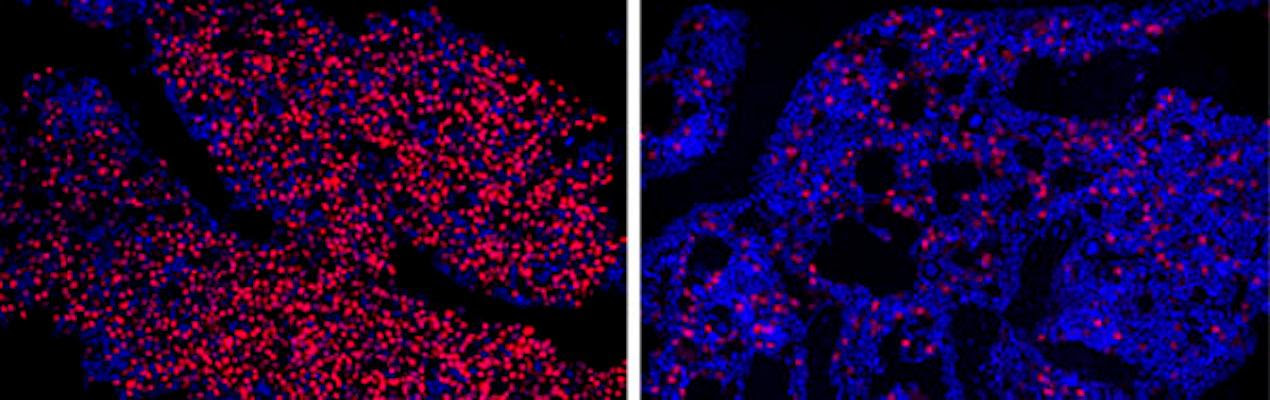 Microscope images of bone marrow from mice with multiple myeloma – the red dots represent IRF4 protein. Left shows a control mouse, compared to the right image of a treated mouse with far less IRF4.