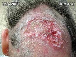 Image result for morgellons in tissue