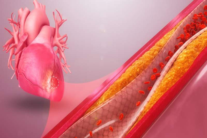 Sphingolipid fingerprint predicts heart disease severity in African American lupus patients