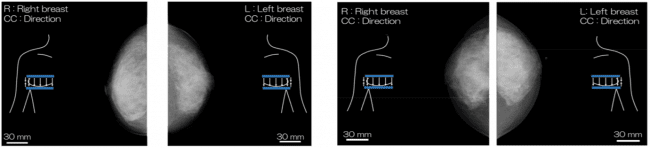 図3：高濃度乳房患者のX線マンモグラフィ画像. 