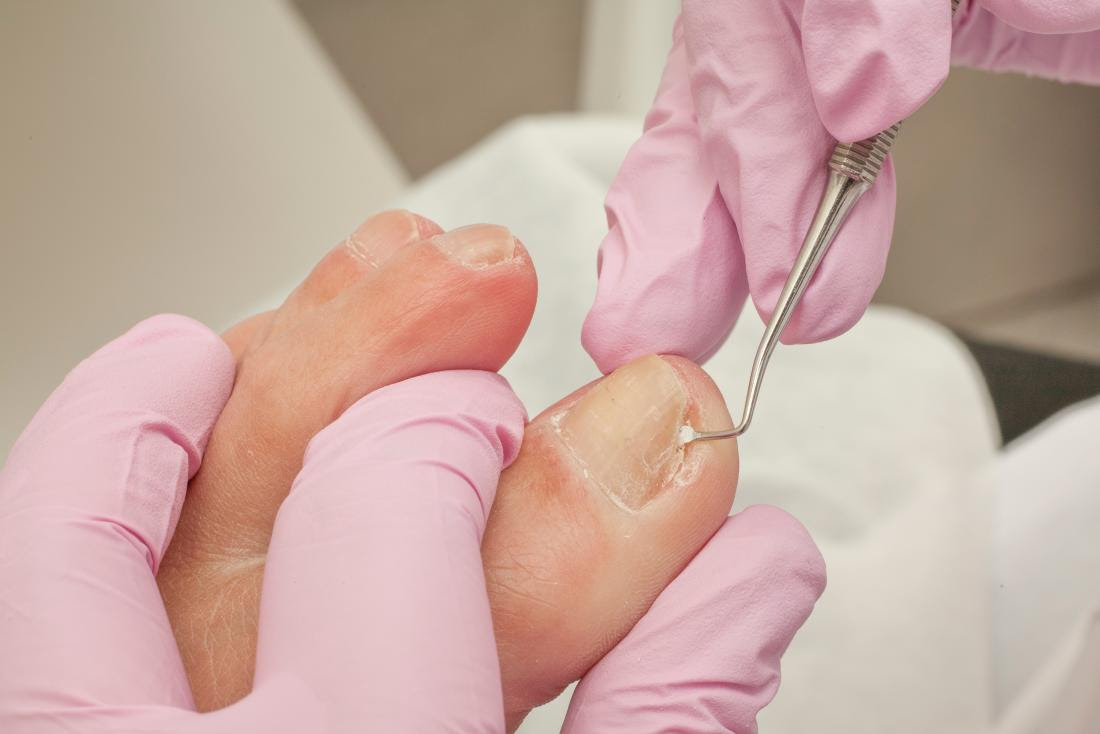 a doctor treating a ingrown nail.