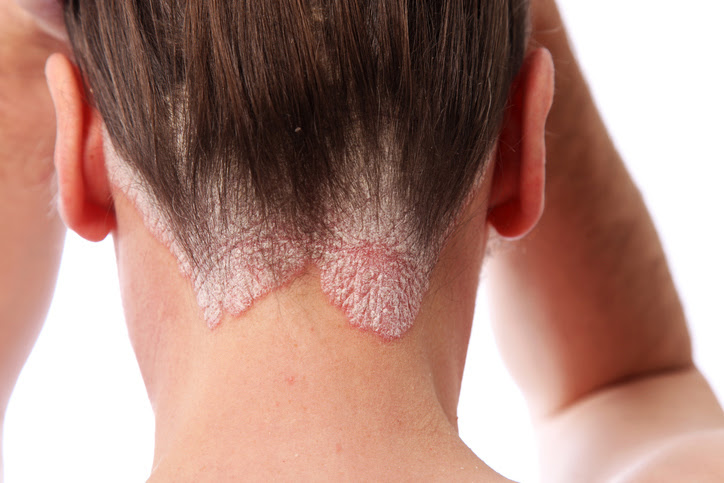 imagen de una mujer con psoriasis en su cuero cabelludo