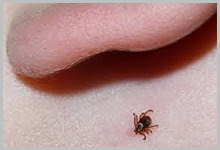An image of a tick on someone's skin. 