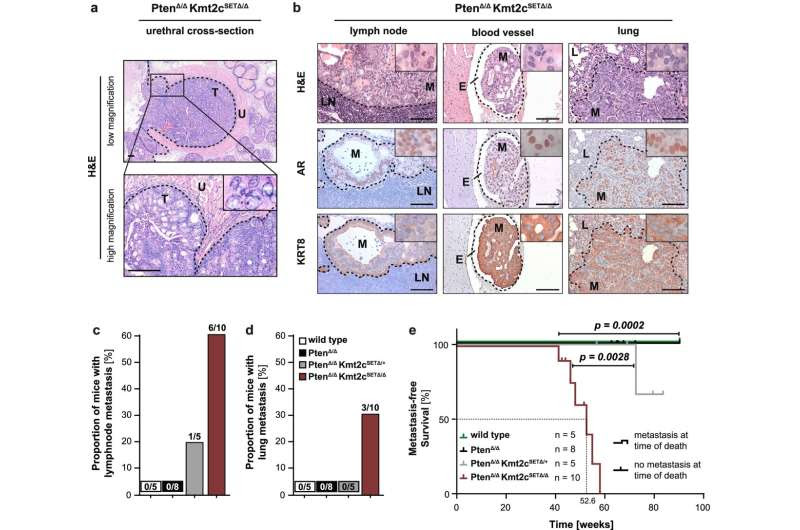 Cause of metastasis in prostate cancer discovered