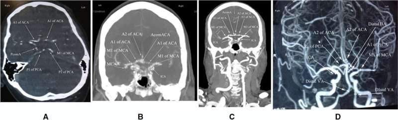 New screening tool identifies people at risk of aneurysms