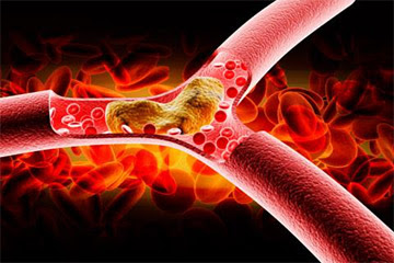 Arteriosclerosis: cómo evitar este factor de riesgo clave de enfermedad cardiovascular