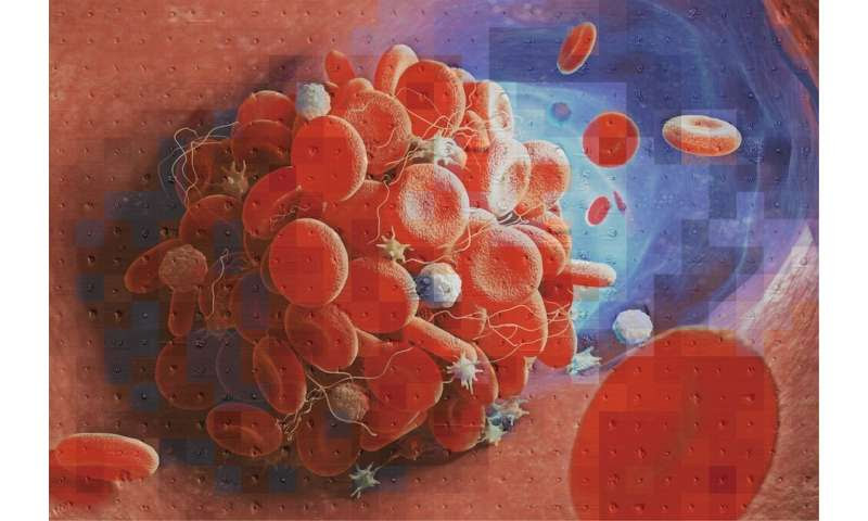 New tool helps distinguish the cause of blood clots