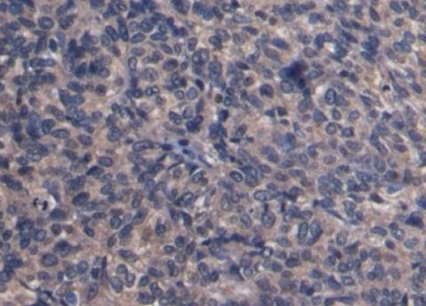 IHC-P analysis of Human Ovarian cancer Tissue, with DAB staining.
