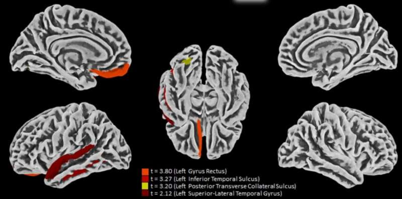 Study reveals main target of SARS-CoV-2 in brain and describes effects of virus on nervous system