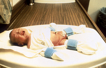 circumcision