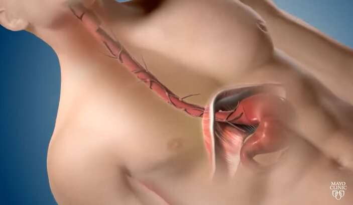 Why early treatment of esophageal cancer is critical