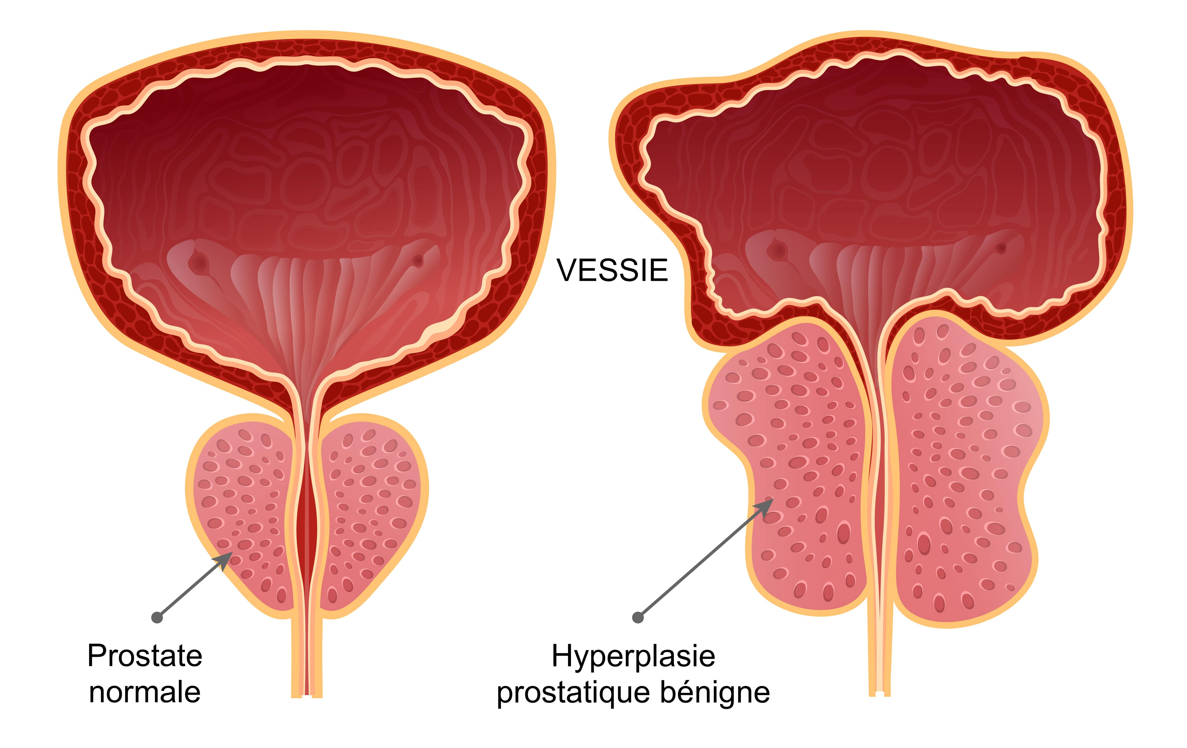schéma : Hyperplasie de la prostate bénigne comparée à une Prostate normale