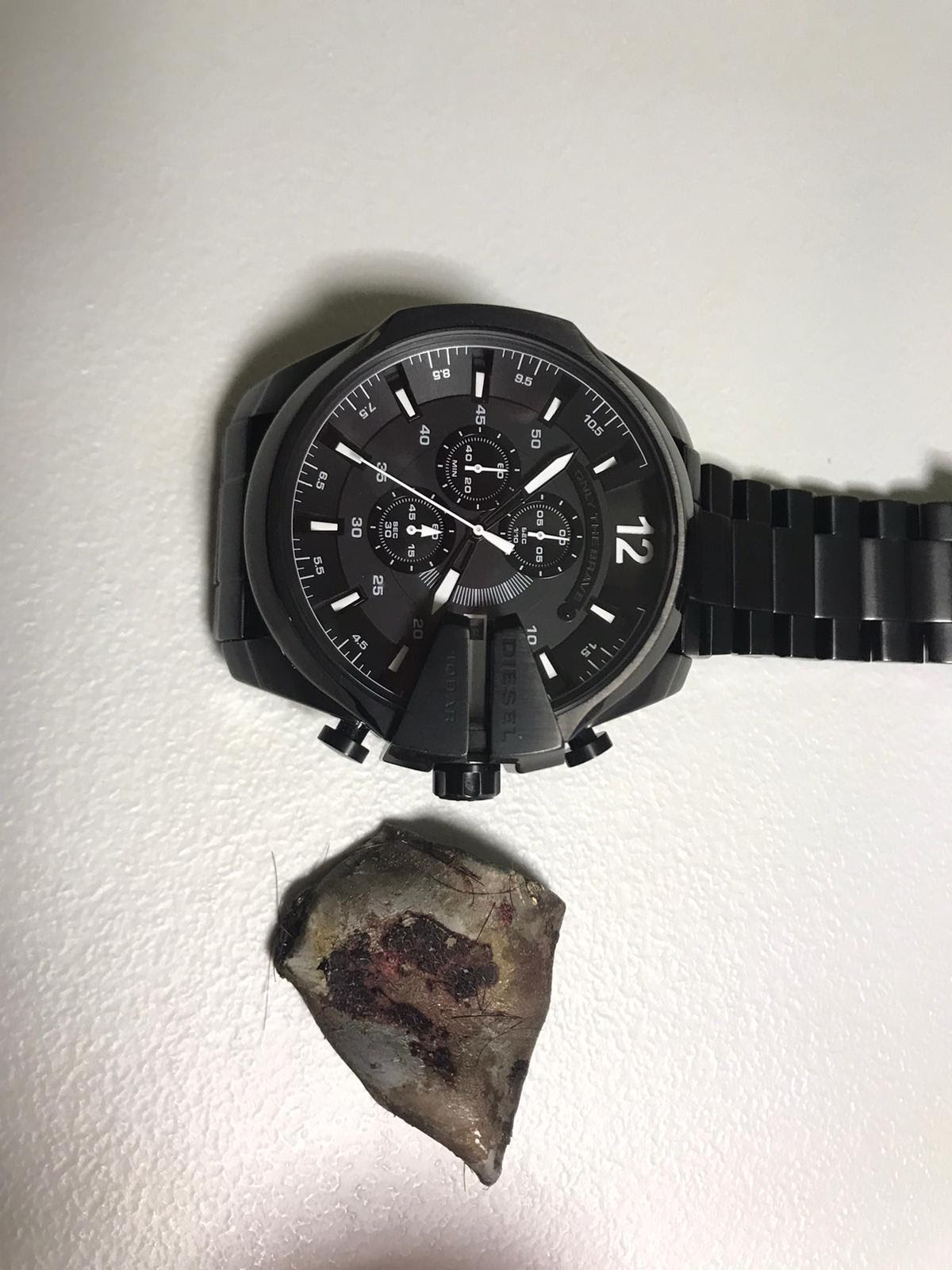 Metralla de la mida d'un rellotge de polsera que van extreure del cap de Felipe Rendón, treballador de l'empresa afectada per l'explosió a la petromquímica de Tarragona. // RAC1
