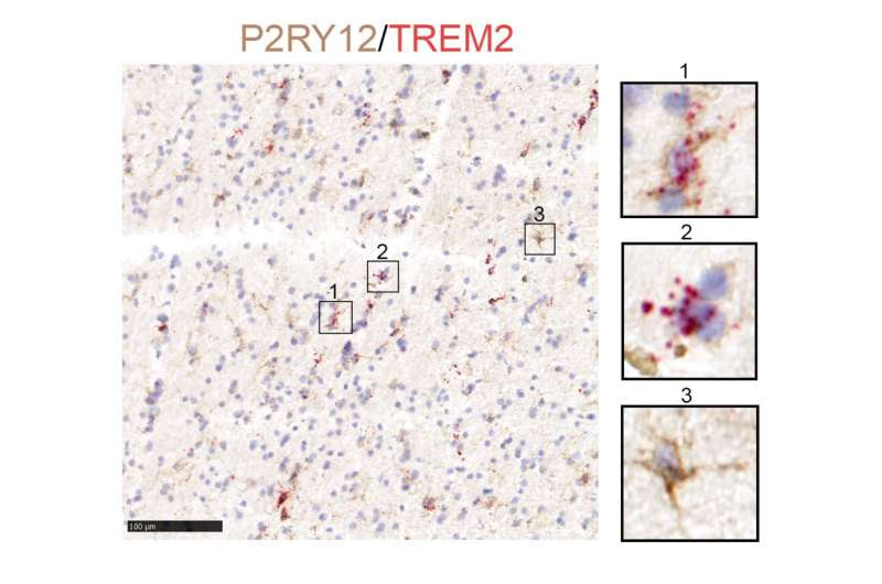 Transcriptomic changes in glia linked to specific neurodegenerative diseases