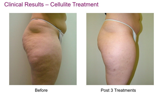 cellulite treatment