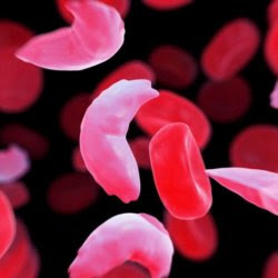 ui health validates cure for sickle cell in adults healthinnovations