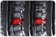 An injection of nanoparticles for spinal cord injuries