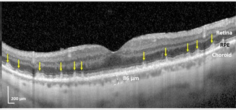 Blinding eye disease strongly associated with serious forms of cardiovascular disease