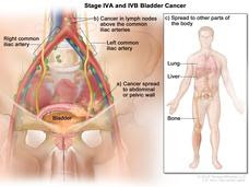 Bladder cancer anatomic drawing
