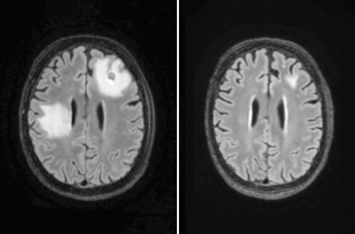 side by side brain scans of man with amoeba infection in brain before and after treatment