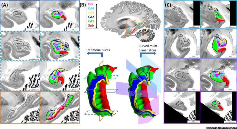 Digitally unfolding the hippocampus to better understand brain disorders