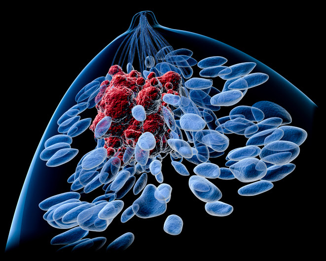 ilustracion de cancer en el seno
