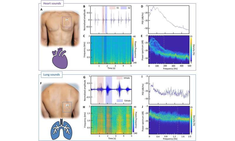 A soft wearable stethoscope designed for automated remote disease diagnosis