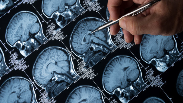 Pesquisa da UFMG desenvolve método para tratar câncer cerebral