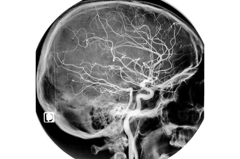 'Cell atlas' of brain vasculature connects stroke with novel immune cells