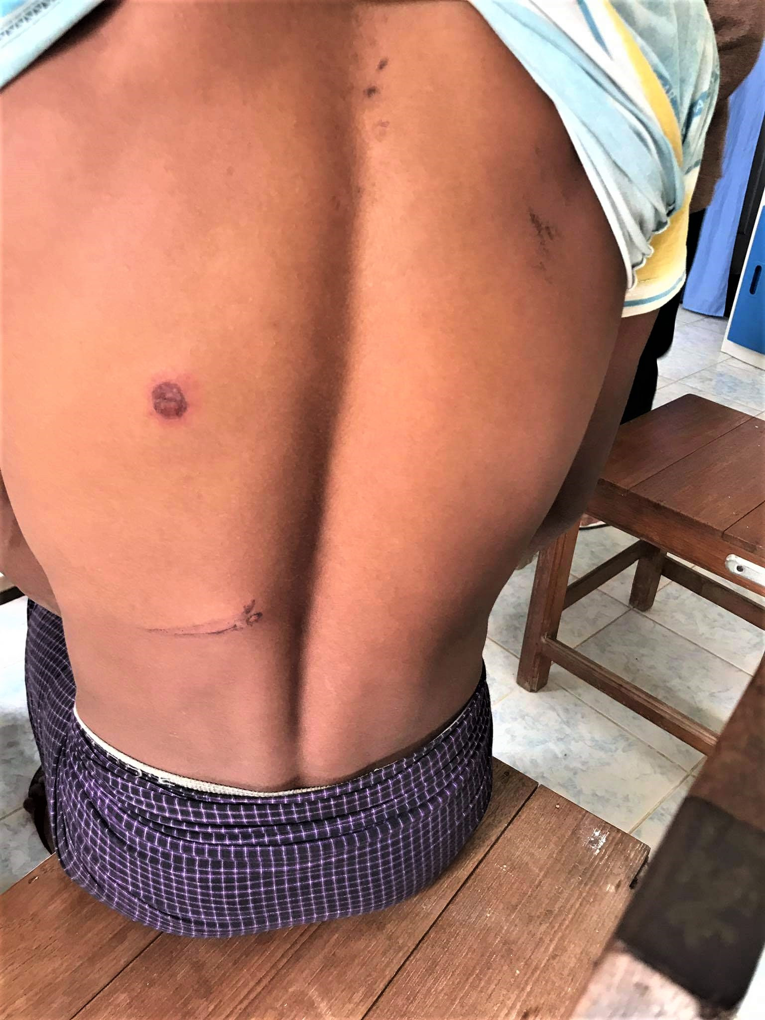  Injured back of Christian in Paw Lwe village, central Burma on Dec. 17, 2018. (Morning Star News)