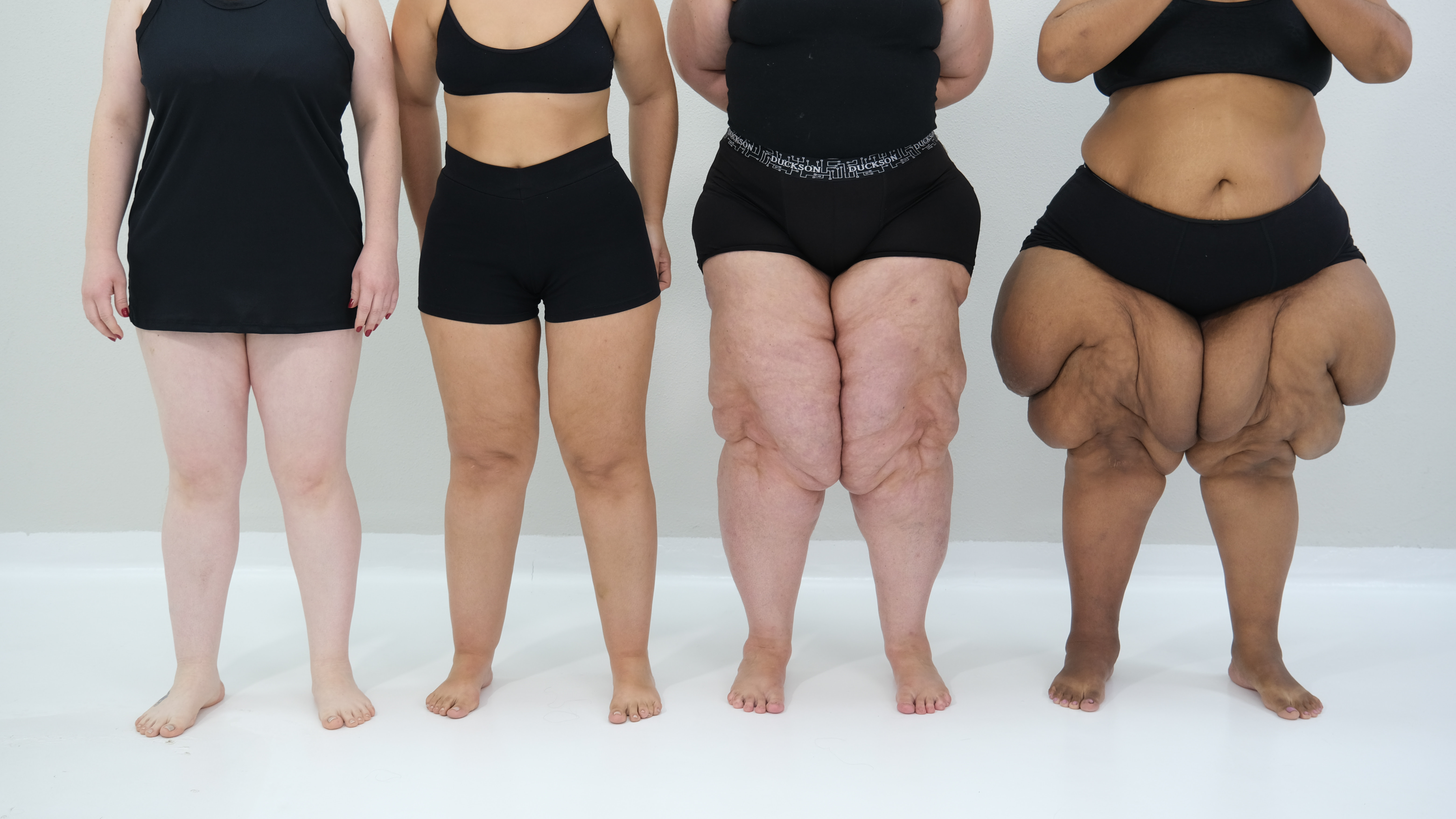 Ajuda para cirurgia de Lipedema