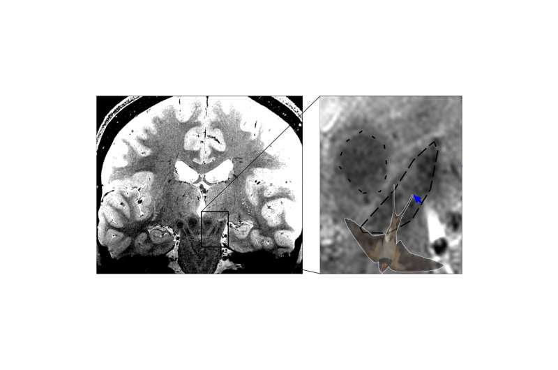 Potential of nigrosome imaging for earlier diagnosis of Parkinson's disease