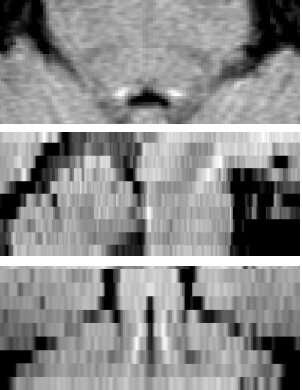 Ultra-powerful brain scanners offer hope for treating cognitive symptoms in Parkinson's disease