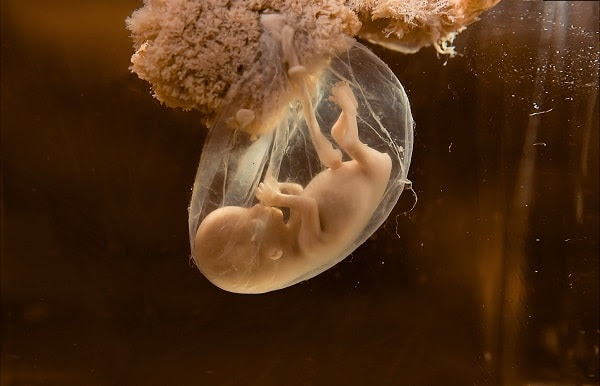 Reducción de embriones
