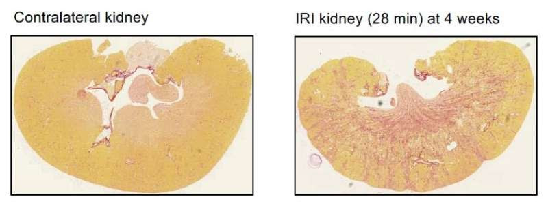 Drug discovery offers potential treatment for common kidney disease