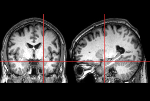 Front-on and profile brains scans show the amygdala highlighted with a red crosshair