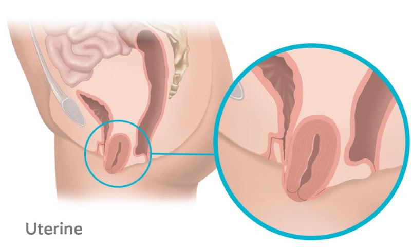 Uterine prolapse occurs when the top part of the vaginal wall loses support and the uterus drops into the vagina.